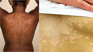 What is Tinea Versicolor Causes Treatment [upl. by Christoforo]