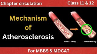 Steps of Atherosclerosis in urdu hindi  Pathogensis Explained for students  Ahterosclerosis [upl. by Cioffred]