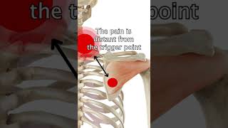 Infraspinatus Trigger Points [upl. by Daza]