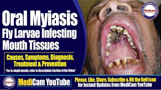 Oral Myiasis Infesting Mouth Tissues  Causes Symptoms Diagnosis and Treatment  Medicam YouTube [upl. by Ettezyl987]