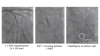 PostPCI FFR and pullback assessment for bifurcation lesion in multivessel disease [upl. by Baelbeer]