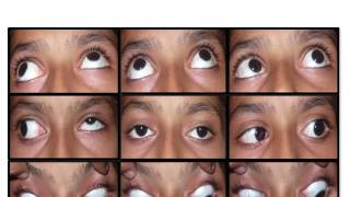 Evaluation of Restrictive Strabismus [upl. by Dray]