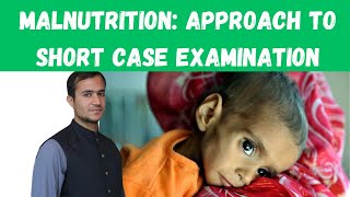 Approach to short case of Malnutrition  Malnutrition in Paediatrics Malnutrition case presentation [upl. by Elbertina]