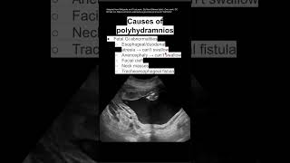 Causes of polyhydramnios [upl. by Hambley]