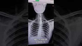 Barium swallow xray procedure xraybariumswallowradiographer medical [upl. by Dielu]