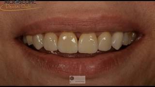 Laminate veneers from preparation to cementation [upl. by Baelbeer627]