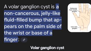 Volar Ganglion Cyst and How I got rid of mine in 2 weeks NonSurgical NoPopping NoNeedles [upl. by Lenoj]