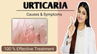 Urticaria treatment  Hives causes symptoms prevention and treatment [upl. by Hajidak]