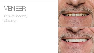 A new smile with edelweiss VENEERs [upl. by Hassin]