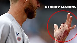 MLB• Worst And Bloodiest Injuries [upl. by Aimek]