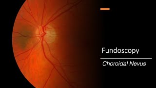 Choroidal Nevus Fundoscopy [upl. by Suirtemed216]