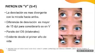 Patrones Alfabéticos en Estrabismos Síndromes A y V [upl. by Eirellam]