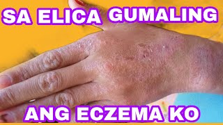 MABISA TALAGA SA ECZEMA ANG ELICA [upl. by Benco]