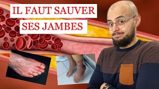 ARTÈRES des jambes BOUCHÉES et ULCÈRE de la PEAU ce quil faut savoir [upl. by Einahpad]