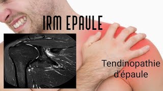 IRM DE L’EPAULE  tendinopathie [upl. by Neicul]