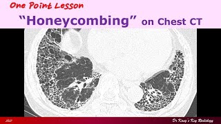 Honeycombing on Chest CT [upl. by Audre]