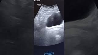 URINARY BLADDER PROLAPSE OR CYSTOCELE usgurinarybladderradiology [upl. by Leban]