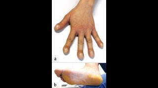 Trommelschlegelfinger und Uhrglasnägel bei primärer hypertropher Osteoarthropathie Typ 1 [upl. by Ynatsed93]