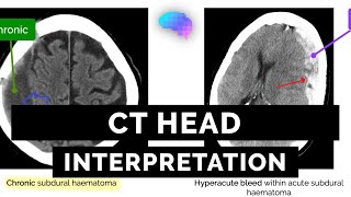 CT Head Interpretation for Beginners  OSCE Guide  UKMLA  CPSA [upl. by Ixel]