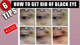 6 TIPS HOW TO GET RID OF A BLACK EYE FAST  WITH BEFORE amp AFTERS [upl. by Thorr]