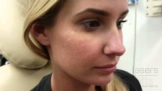 Removing acne scars in 5 minutes [upl. by Wahl]