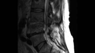 Discitis Osteomyelitis [upl. by Gnuhp433]