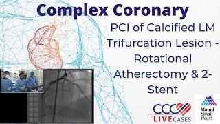 PCI of Calcified LM Trifurcation Lesion  Rotational Atherectomy amp 2Stent  CCC Live May 2017 [upl. by Sirtimid]