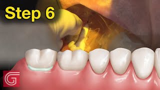 HOW TO Cement Zirconia Crown for Less Retentive Tooth Prep [upl. by Gaut610]