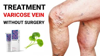 Best Medicine for Varicose vein 2023  Varicose vein Treatment without Surgery [upl. by Yurik]