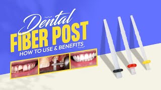 Dental Fiber Post  How To Use amp Benefits  Dentalkart [upl. by Logan311]