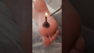 Deep tissue massage and moxibustion therapy for Evelin deeptissuemassage [upl. by Harrod26]