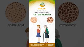 Understanding Osteoporosis Stages Care and Prevention at Sanjivi Hospitals [upl. by Ahtel154]