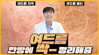 피부과 전문의가 알려주는 여드름 자국과 흉터 feat관리 꿀팁 [upl. by Aala]