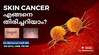 Skin cancer എങ്ങനെ തിരിച്ചറിയാം Dr Bishurul Hafi MD [upl. by Nolan]