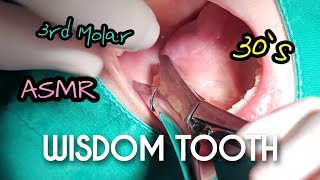 ASMR Wisdom Tooth Extraction in 1 Minute [upl. by Oinota57]