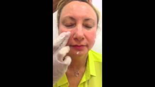 Mirvaso treatment for facial redness caused by rosacea [upl. by Tram]