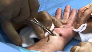 Endoscopic carpal tunnel surgery  Carpale tunnel syndroom kijkoperatie [upl. by Nemra175]