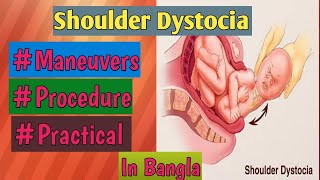 Shoulder Dystociya Procedure in Bangla Management  শোল্ডার ডিস্টোসিয়া [upl. by Enenaj]