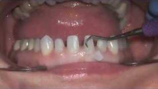 Veneer Temp Removal [upl. by Vadim]