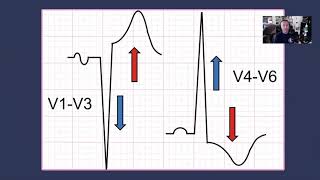 Left Ventricular Hypertrophy [upl. by Dew]