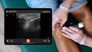 Ultrasound Informed Parapatellar Injection [upl. by Ninel]