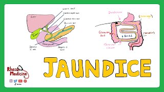 JAUNDICE Differential diagnosis of Jaundice  PrehepaticHepaticPost Hepatic Causes of Jaundice [upl. by Dieter288]