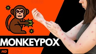 Monkeypox Everything You Need To Know [upl. by Proffitt830]