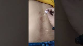 Dry Acupuncture needles for back pain Treatment [upl. by Tavia953]