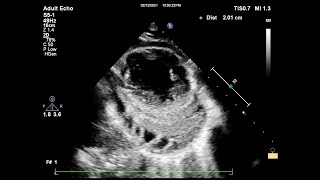 Constrictive pericarditis echocardiography [upl. by Milman]