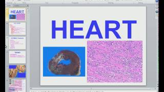 Medical School Pathology 2012 Session 041 Heart Imp4 [upl. by Rawlinson]