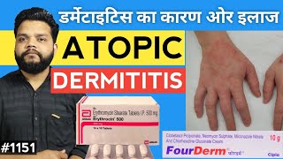 Atopic Dermatitis In Hindi  Causes Symptoms amp Treatment [upl. by Sillek]