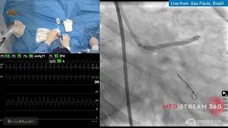 FFR and IVUSGuided Single Stent PCI From LM to Ostial LAD [upl. by Lev]