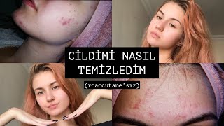 SİVİLCELERİMDEN NASIL KURTULDUM ✨ roaccutane’sız [upl. by Llennoc]