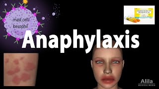 Anaphylaxis Animation [upl. by Sile938]